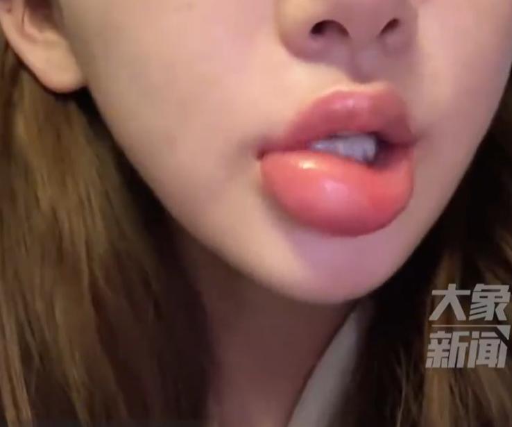 女生半夜嗦田螺肿成香肠嘴真相来了